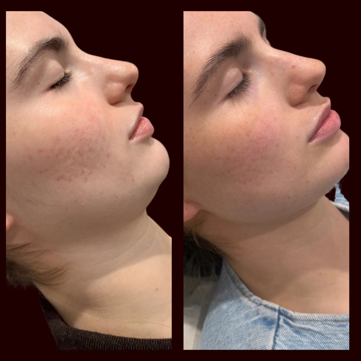 Before and after NeoGen plasma treatment showing smoother skin and reduced acne scarring on the cheek. Image courtesy of NeoGen.