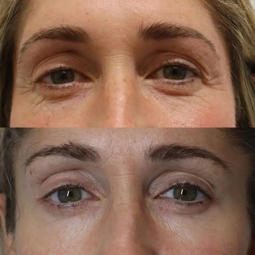 Before and after NeoGen plasma treatment around the eyes showing smoother, less crepey skin. Image courtesy of NeoGen.