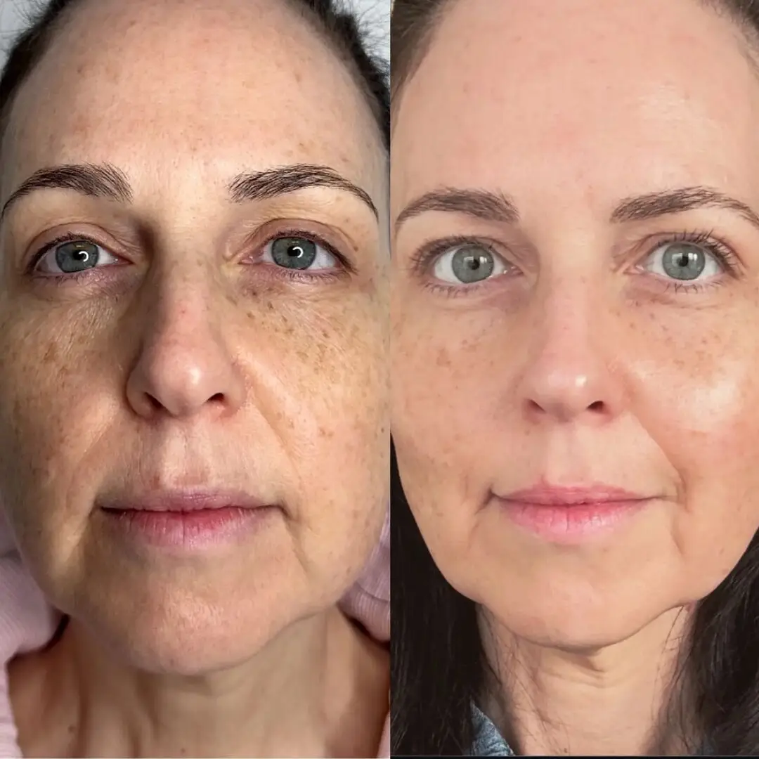 Before and after NeoGen plasma treatment showing improved skin tone, pigmentation and texture on the face. Image courtesy of NeoGen.