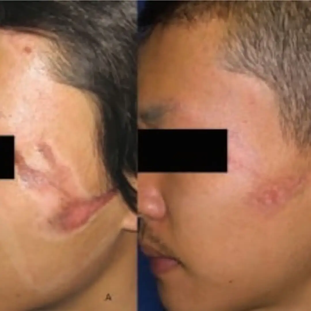 Before and after NeoGen plasma treatment showing a softened facial scar. Image courtesy of NeoGen.