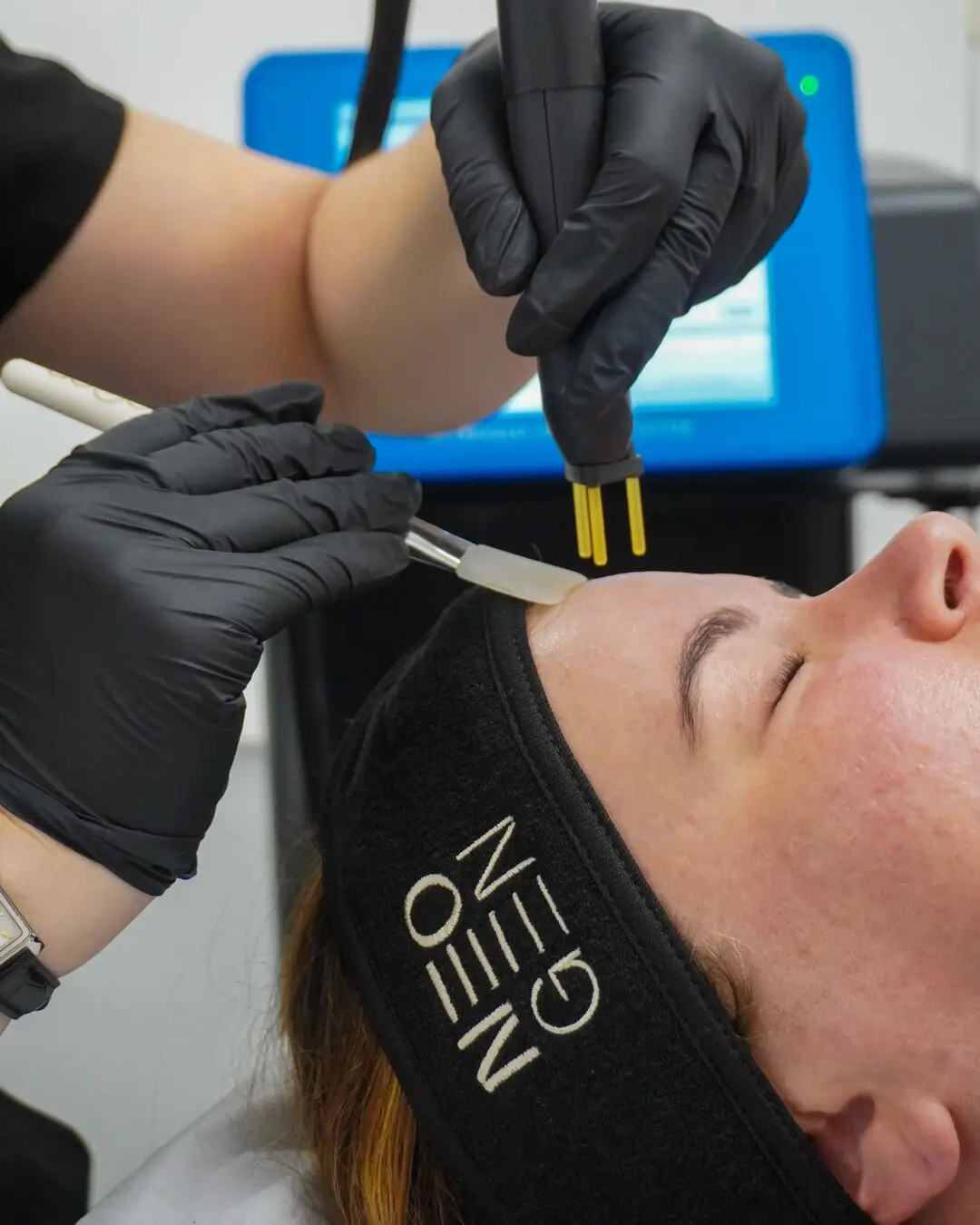 Practitioner performing NeoGen nitrogen plasma skin regeneration treatment on a patient’s forehead